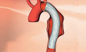 Thorakaler Stentgraft E-vita thoracic Thorakaler Stentgraft E-vita thoracic